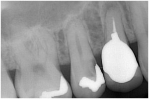 小泉1　抜髄　◎